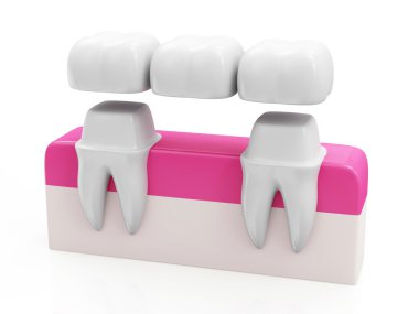 Dental Bridge Concept clipart