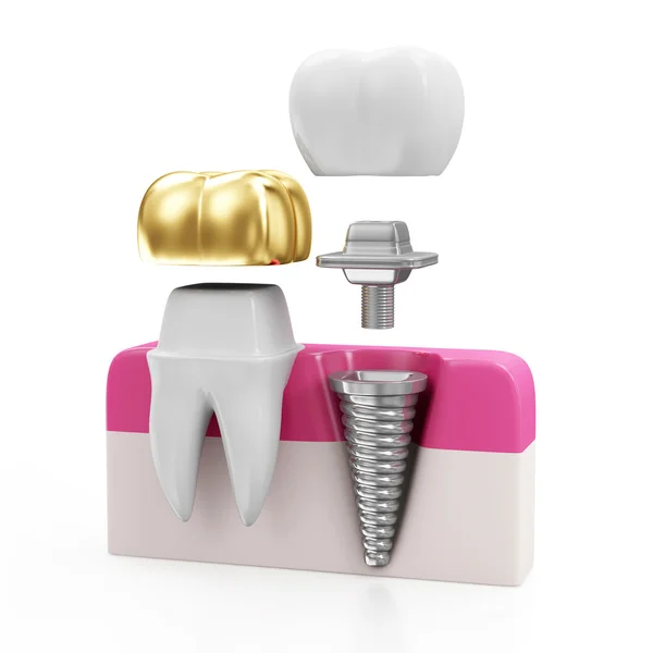 Ząb ze złotą koronę i implantu — Zdjęcie stockowe
