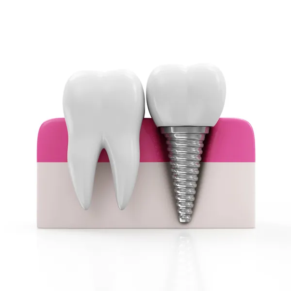 Ząb zdrowia i dental implant — Zdjęcie stockowe