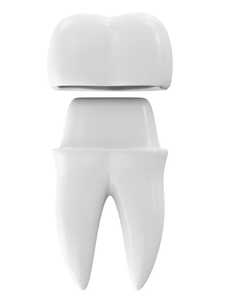 Стоматологічна корона на зубі — стокове фото