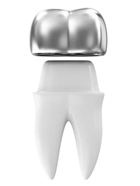 Coroa dentária de prata em um dente — Fotografia de Stock