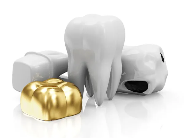 Tandheelkundige kroon en tanden — Stockfoto