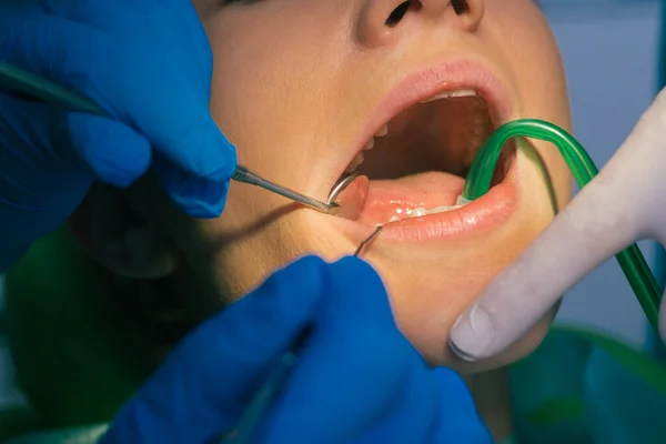 Closeup Exame Dental Limpo Sobre Dentes Uma Mulher Consultório Odontológico — Fotografia de Stock