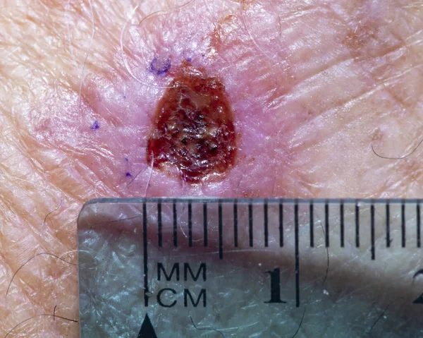 Skin cancer incisional biopsy site on the back of a male hand.