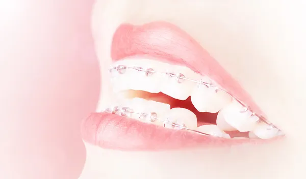 Glückliches Mädchen mit Zahnspange — Stockfoto
