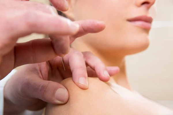 Médico mãos acupuntura agulha picando mulher — Fotografia de Stock