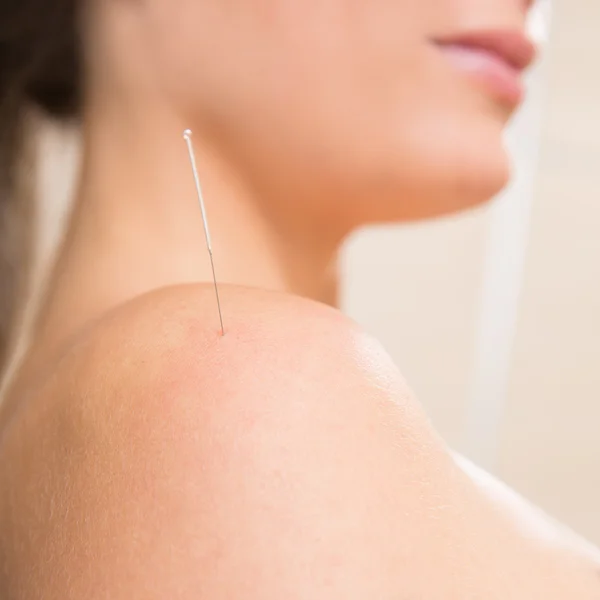 Acupuncture needle pricking on woman shoulder — Stock Photo, Image