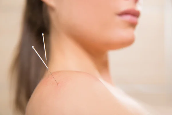 여자 어깨에 찌르는 침술 바늘 — 스톡 사진