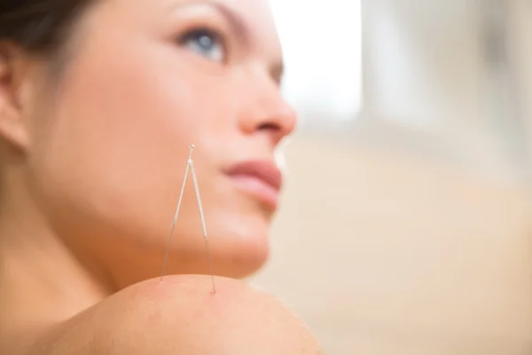 Acupuncture needle pricking on woman shoulder — Stock Photo, Image