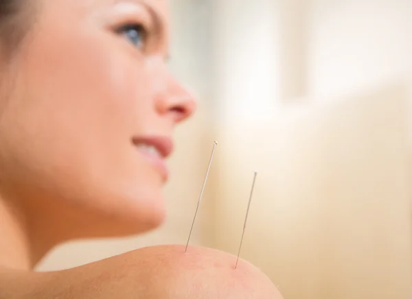 Aguja de acupuntura pinchando en hombro de mujer — Foto de Stock