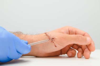 Dermatoloji prosedüründen kalma dikiş yarası.