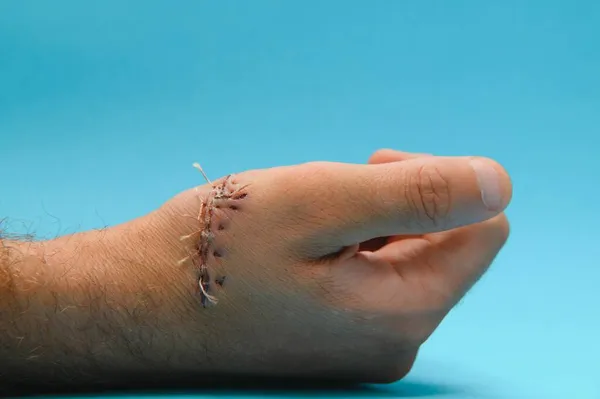Mão Ferida Suturando Ferida Tipo Corte Após Cirurgia — Fotografia de Stock