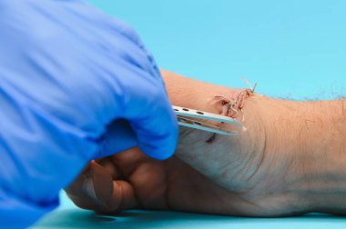 Karpal tünel sendromundan sonra avucundaki sinir iletimini inceleyen doktor.