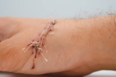 Dermatoloji prosedüründen kalma dikiş yarası.