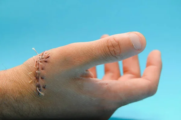 Gewond Bij Hand Pijn Van Het Ongeval Concept — Stockfoto