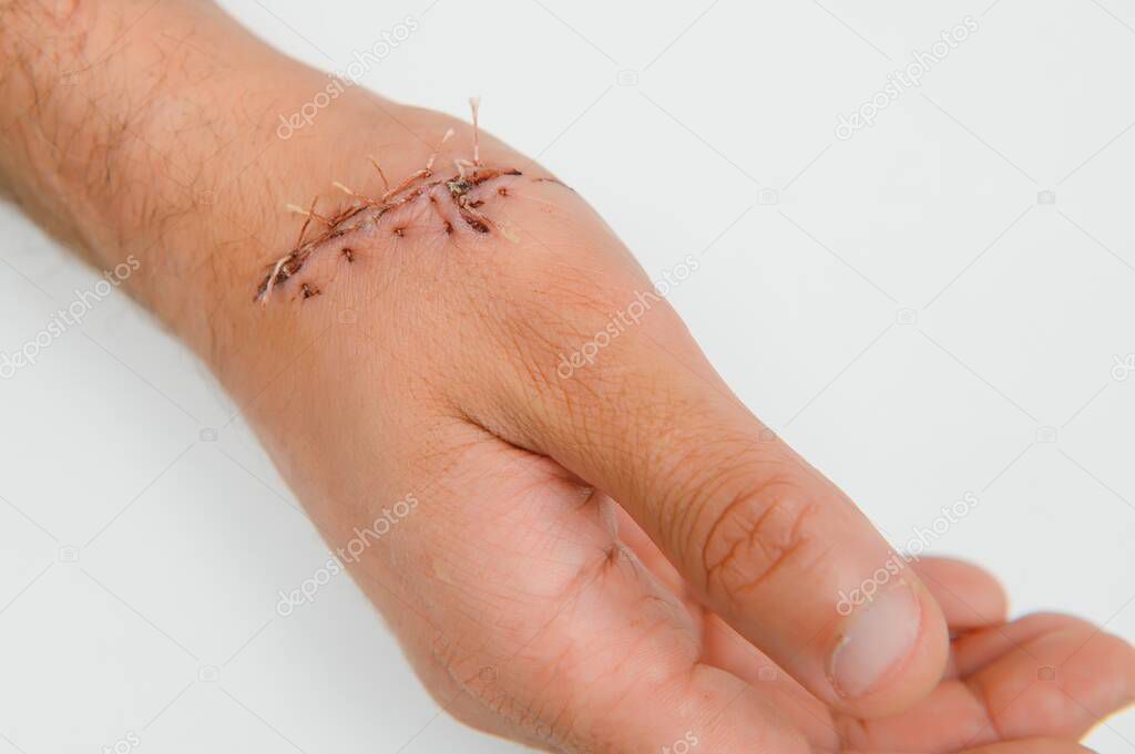 Suture wound on hand, Pain of accident concept