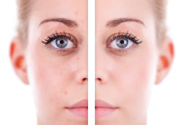 Caucasian woman's face skin , beauty concept before and after co — Stock Photo, Image