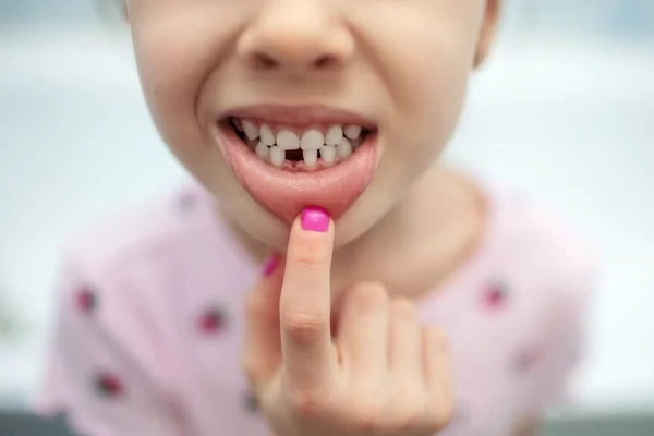 Child Girl Shows Her Mouth One Missing Tooth Close Lost — Stock fotografie