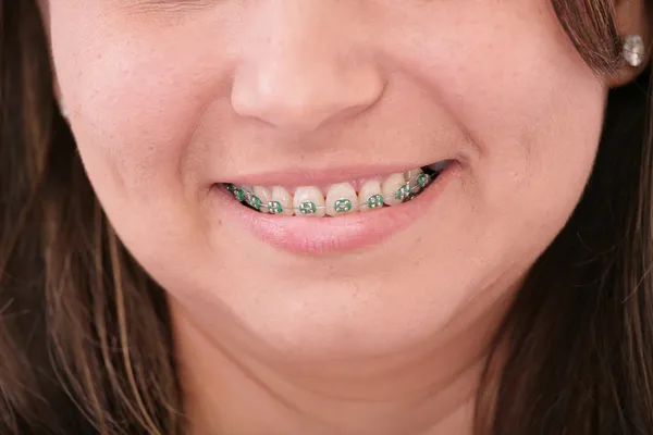 Teeth with braces — Stock Photo, Image