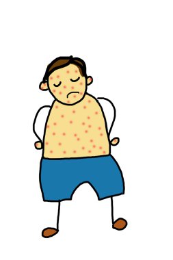 küçük oğlum su çiçeği ile hasta 