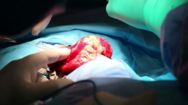 Akciğer amfizem cerrahisi