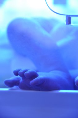 Yenidoğan sarılığı