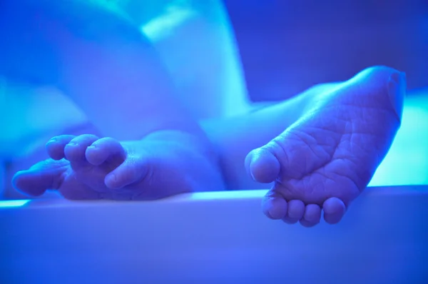 Newborn jaundice — Stock Photo, Image