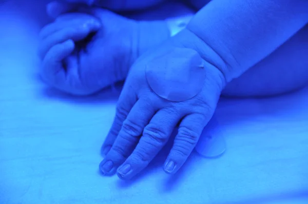 Newborn jaundice — Stock Photo, Image