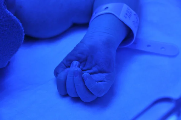 Ictericia neonatal —  Fotos de Stock