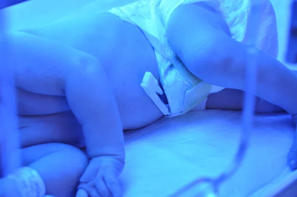 Новорожденная желтуха — стоковое фото