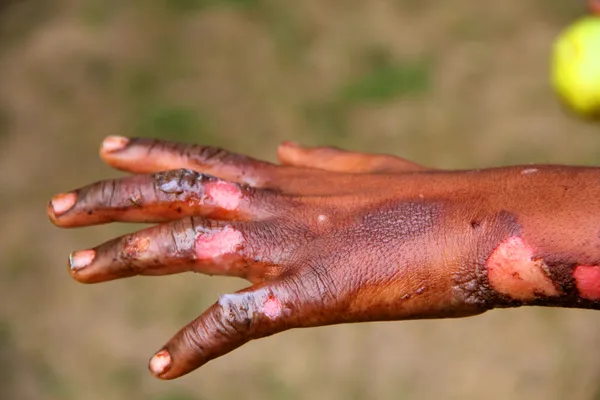 Lesiones por quemaduras en la mano — Foto de Stock