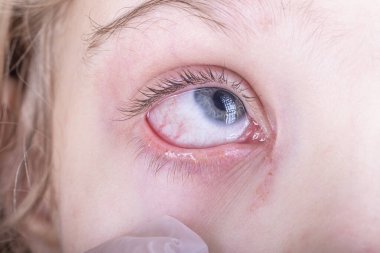 Yakın plan. Beyaz saçlı bir kız. Gözünden yaş akar, kırmızıdır, iltihap boşalır. Deri döküntüsü Çok güçlü bir parçalanma. Doktor muayenesi
