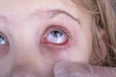 Yakın plan. Beyaz saçlı bir kız. Gözünden yaş akar, kırmızıdır, iltihap boşalır. Deri döküntüsü Çok güçlü bir parçalanma. Doktor muayenesi