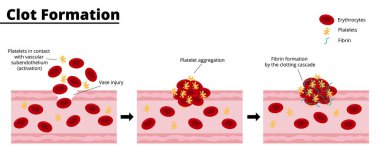Clot formation process after a bleeding vascular injury. Platelet aggregate formation. Formation of fibrin by the clotting cascade. Vector illustration. Didactic illustration. clipart