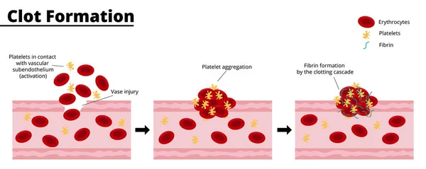 Clot formation process after a bleeding vascular injury. Platelet aggregate formation. Formation of fibrin by the clotting cascade. Vector illustration. Didactic illustration.
