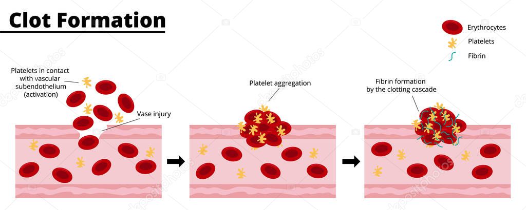 Clot formation process after a bleeding vascular injury. Platelet aggregate formation. Formation of fibrin by the clotting cascade. Vector illustration. Didactic illustration.