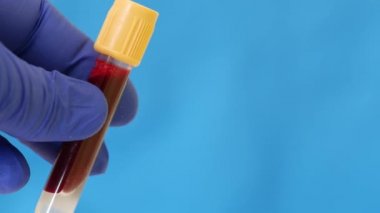 İnsan kanı konteynırı. Mavi nitrile eldiveni içinde kan olan test tüpü taşıyor.