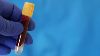 İnsan kanı konteynırı. Mavi nitrile eldiveni içinde kan olan test tüpü taşıyor.