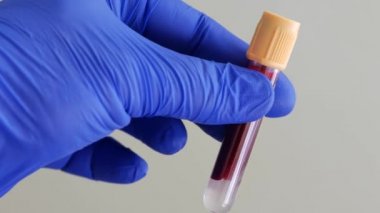 İnsan kanı konteynırı. Mavi nitrile eldiveni içinde kan olan test tüpü taşıyor.