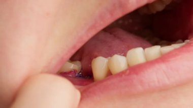 Close-up surgical stitches applied to gum in persons mouth. Dental surgery for implantation of an implant in gum. Stitches on gum, preparation for implantation of tooth in mouth.