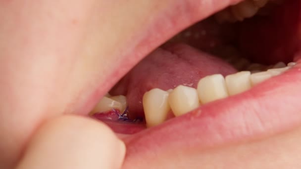 Close-up surgical stitches applied to gum in persons mouth. Dental surgery for implantation of an implant in gum. Stitches on gum, preparation for implantation of tooth in mouth. — Vídeo de Stock