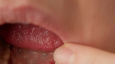 Close-up of stitches on gum in girl mouth. Dental implantation, surgical surgery in mouth. Dentist demonstrates surgical sutures on gum during implantation of implants.