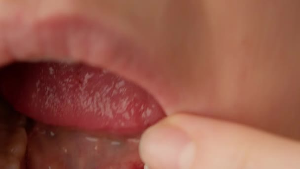 Nærbillede af sting på tyggegummi i piges mund. Tandimplantation, kirurgi i munden. Tandlæge demonstrerer kirurgiske suturer på tyggegummi under implantation af implantater. – Stock-video