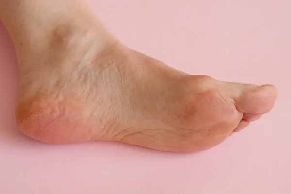 woman\'s hand massaging her bunion toes in bare feet to relieve pain on pink background Woman feet problem. Hallux valgus. Closeup