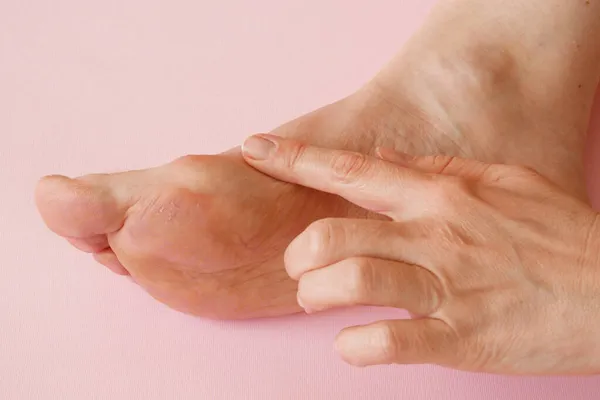 Woman Hand Massaging Her Bunion Toes Bare Feet Relieve Pain — Stock Photo, Image