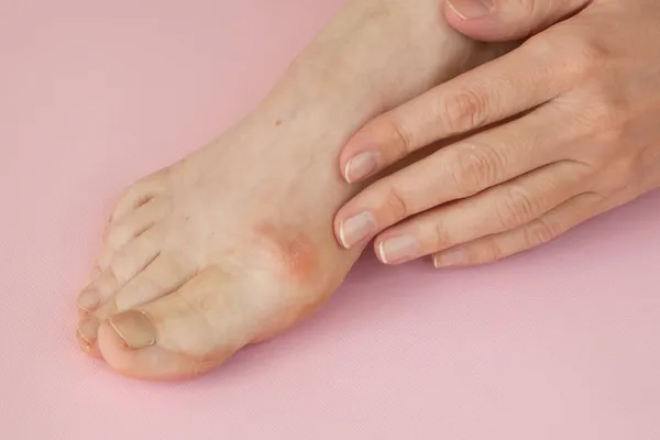 woman\'s hand massaging her bunion toes in bare feet to relieve pain on pink background Woman feet problem. Hallux valgus. Closeup