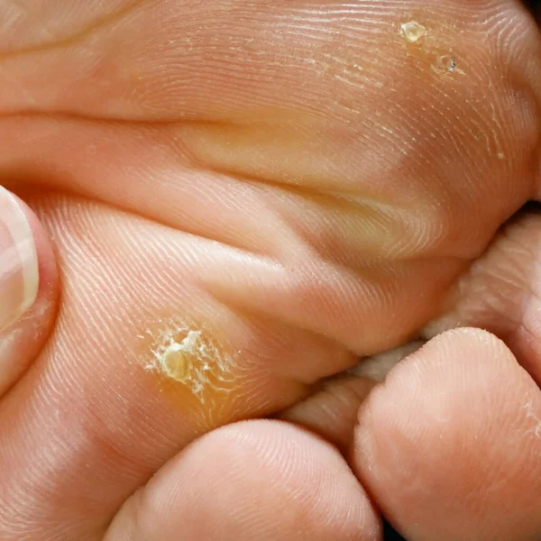 Tratamento Pés Durante Procedimento Mulher Remove Calos Seus Pés Casa — Fotografia de Stock