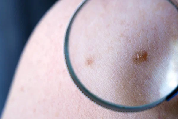 Dermatologista Médico Examina Marca Nascença Paciente Verificando Moles Benignos Close — Fotografia de Stock