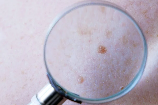 Dokter Dermatologis Memeriksa Tanda Lahir Pasien Memeriksa Mol Jinak Closeup — Stok Foto