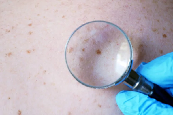Lékař Dermatolog Vyšetřuje Mateřské Znaménko Pacienta Kontrola Benigních Krtků Detailně — Stock fotografie